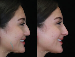 Non-Surgical Nose Lift in Arcadia, CA | TipLyft